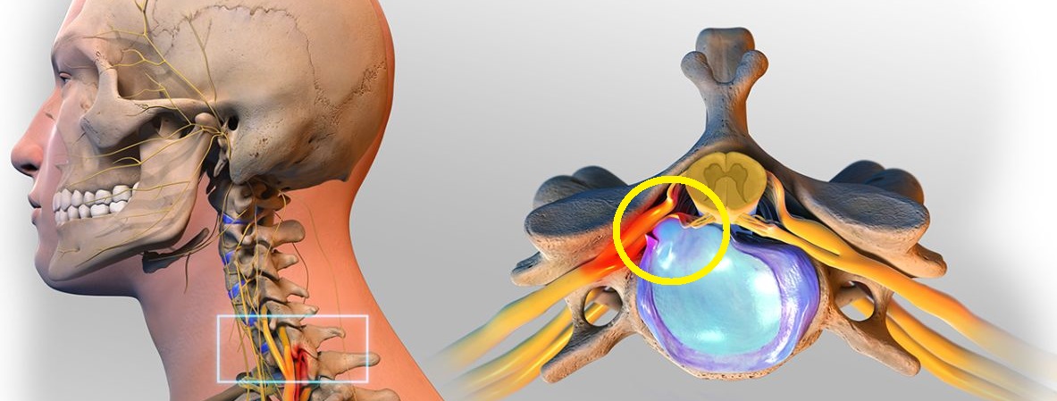 cervical-herniated-disc_circ1083